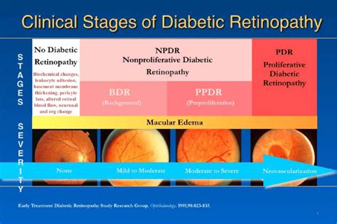 Stages of progression of diabetic retinopathy. Image courtesy of Lloyd ...