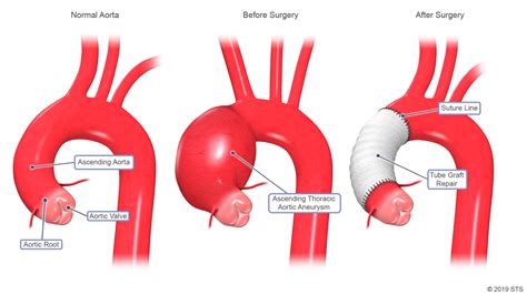 Thoracic Aortic Aneurysm - Newport Cardiac & Thoracic Surgery