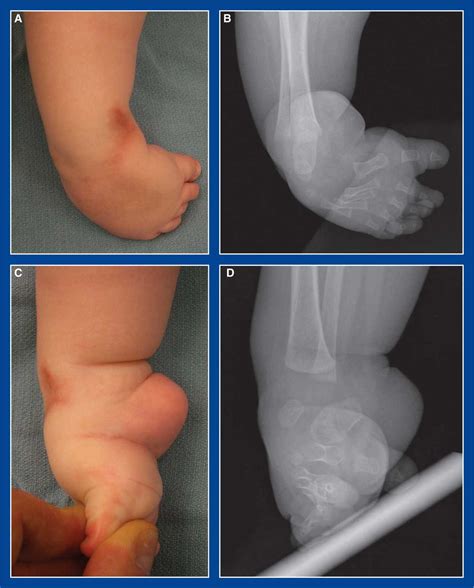 Foot and Ankle Deformities | Musculoskeletal Key