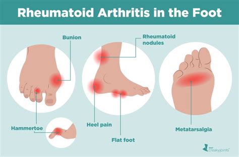 Rheumatoid Arthritis in the Feet: Symptoms and Treatments