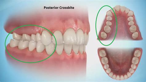 Correction of Cross-Bites / Use of Expanders - Clonmel Orthodontics