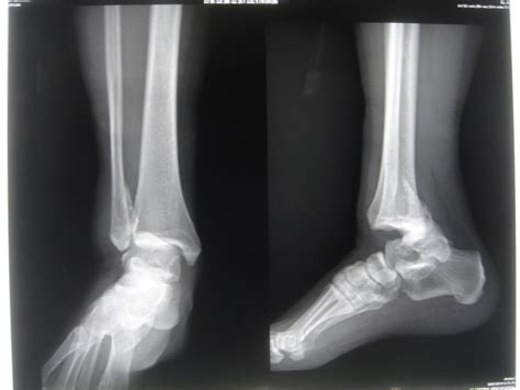 Malleolus fracture