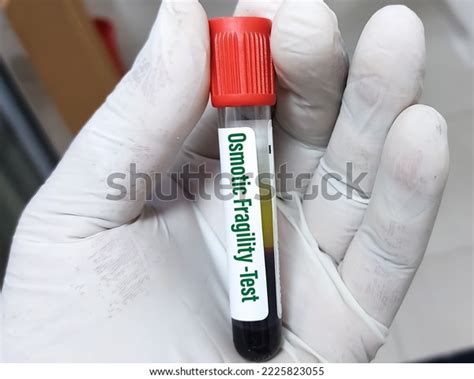 Blood Sample Serum Osmolality Test Diagnosis Stock Photo 2225823055 ...