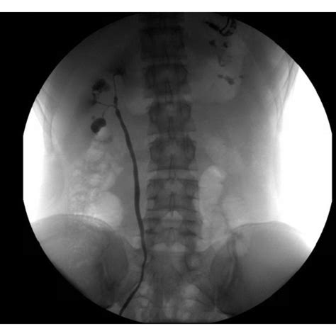 Retrograde pyelogram of right kidney (a) showing stenotic infundibulae ...