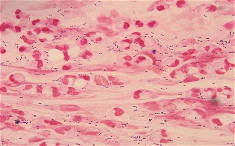 Gram stain of sputum specimen | Medical Laboratories