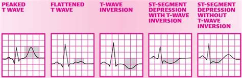 Unstable Angina Ecg