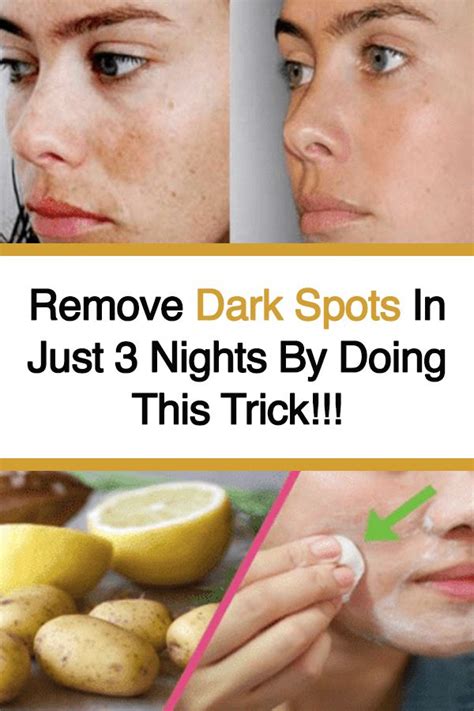 Remove Dark Spots In Just 3 Nights By Doing This Trick!!! #Darkspots ...