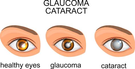 Cataracts, Glaucoma and Detached Retinas … Facing the Challenges of ...