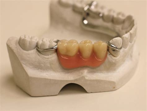 Dentures: Full and Partial, False Teeth Options & Costs UK