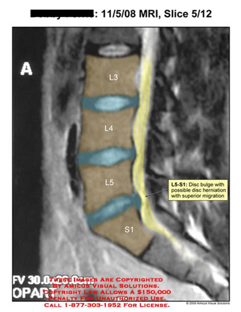 AMICUS Illustration of amicus,radiology,mri,lumbar,spine,L5-S1,disc,bulge