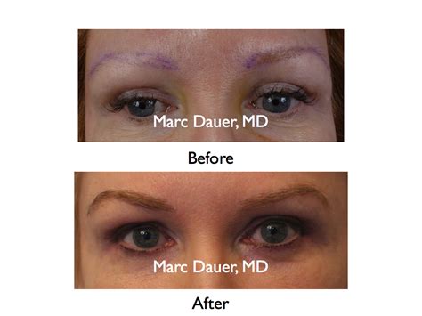 Eyebrow Transplant Patient- Before and After | Marc Dauer, MD