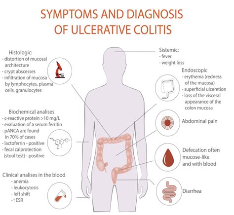 How is Ulcerative Colitis Diagnosed? | The IBS & Gut Health Clinic