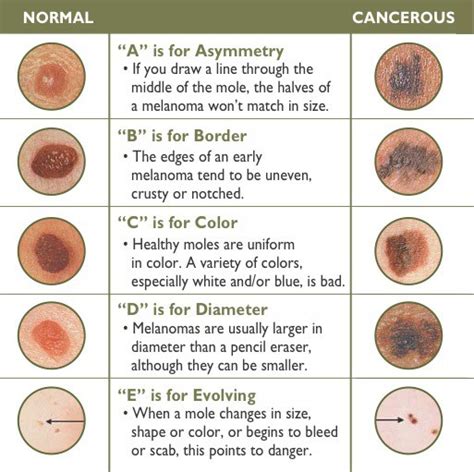 Types of Skin Cancers | Dermatologist Woodlands | Houston | Katy Texas