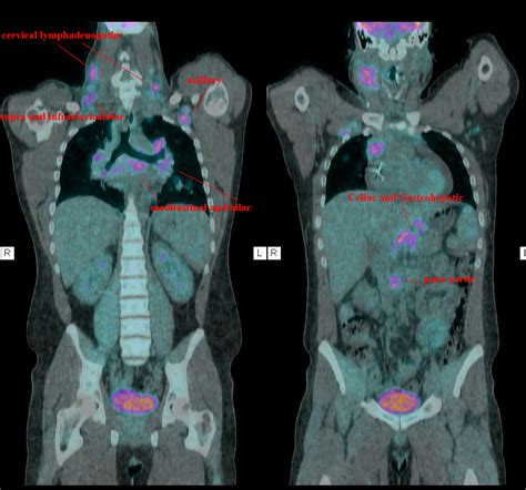 Kicking the Hodge: PET Scan Results