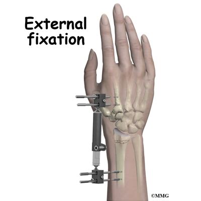 Adult Wrist Fractures - Midwest Bone and Joint Institute - Illinois