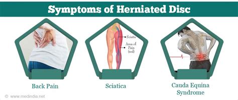 Herniated Disc - Causes, Symptoms, Diagnosis, Treatment, Complications ...