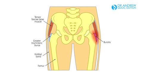 Hip Bone Pain, Where Is This Pain Coming From? (2022)