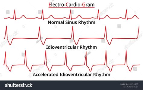 What Accelerated Idioventricular Rhythm Looks Like On Your, 56% OFF