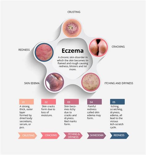 Know more about #Eczema | #Eczema | #Atopic Dermatitis | #Seborrheic ...