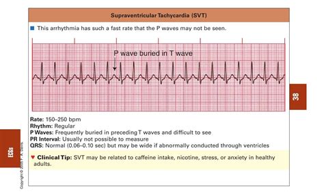 Paroxysmal Supraventricular Tachycardia Heart | Images and Photos finder