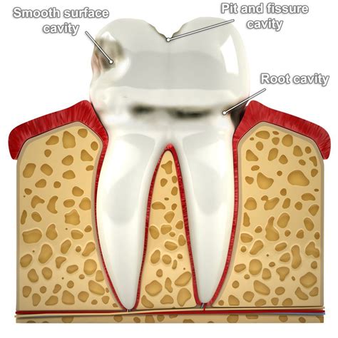 What is a Gumline Cavity? - Channo DDS