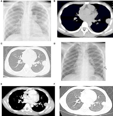 Frontiers | An isolated pulmonary nodule secondary to Streptococcus ...