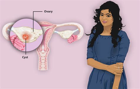 Ovarian Cyst Symptoms > Laparoscopycures