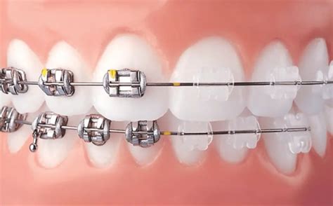 TOP 10 Benefits of Clear Bracket Braces (Keep Your Smile Bright)