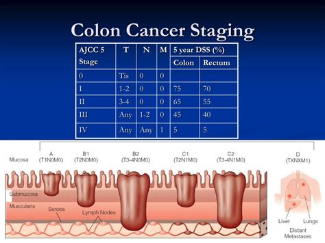 Colorectal Cancer Stages