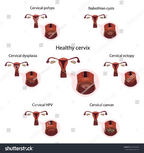 Hpv And Cervical Polyps