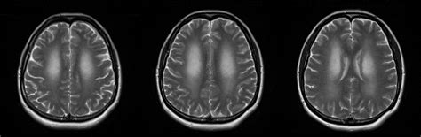 A Case of Hashimoto Encephalopathy With Long-Term Follow-Up | Consultant360