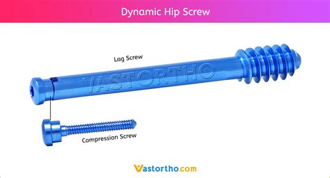 Dynamic Hip Screw Uses, Sizes & Surgical Technique • Vast Ortho