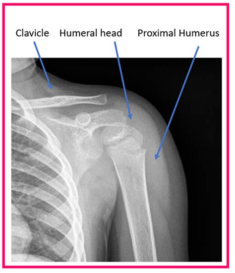 Humerus Fracture: Types, Symptoms Treatment, 46% OFF