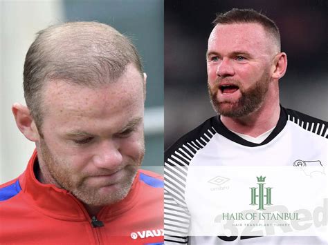 Wayne Rooney Hair Transplant: The Story Behind His New Look!