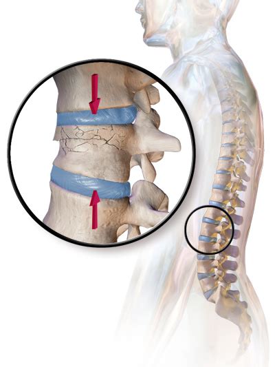 Vertebral compression fracture - Wikipedia