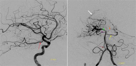 Posterior Cerebral Artery | neuroangio.org