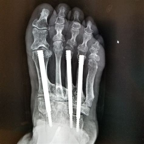 Charcot Reconstruction | Foot surgery