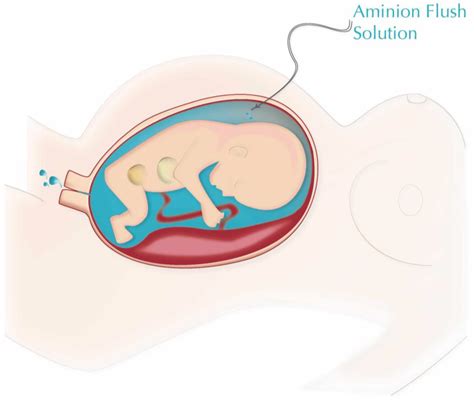 Life | Free Full-Text | Treatment of Classic Mid-Trimester Preterm ...