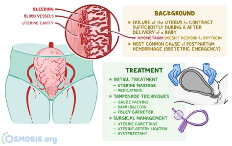 Uterine Atony: What Is It, Risk Factors, Treatment | Osmosis