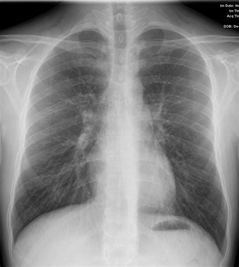 Chest X Ray Bronchitis Images