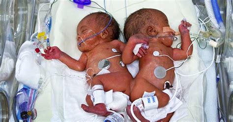 Conjoined twins separated after 13-hour surgery (PICTURES) - CBS News