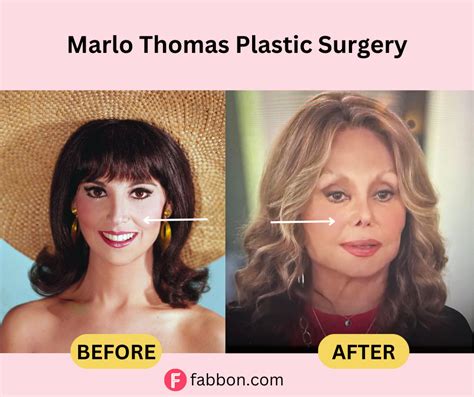 Marlo Thomas Plastic Surgery Secrets: Before And After Photos | Fabbon