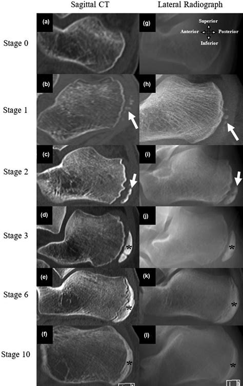 Quantifying the ossification and fusion of the calcaneal apophysis ...