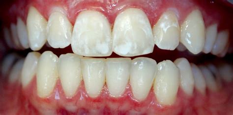 White Spots on Teeth after Braces treatment - Headgear Braces