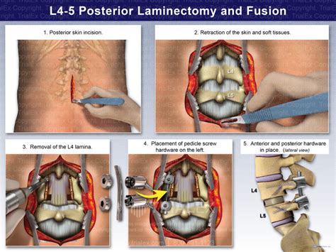 L4-5 Posterior Laminectomy and Fusion - Trial Exhibits Inc.