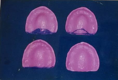 Posterior palatal seal developed with low fusing compound. | Download ...