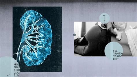 Medullary sponge kidney: Symptoms, diagnosis, and more