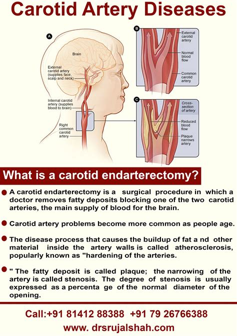 Carotid endarterectomy is a surgical procedure used to reduce the risk ...