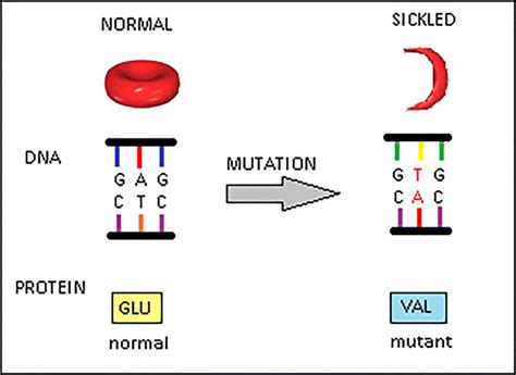 Getting Rid: What is sickle cell anemia?