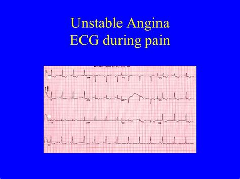 Unstable Angina Ecg